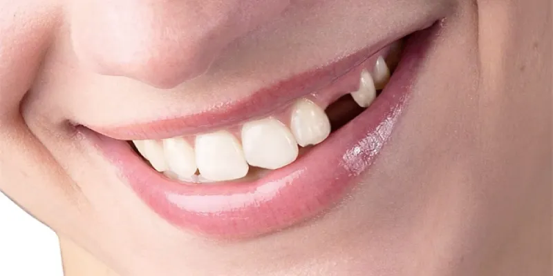 Nằm Mơ Rụng Răng - Giải Mã Những Điềm Báo Đằng Sau Giấc Mơ 4 Lưu ý hội viên cần biết khi chiêm bao thấy rụng răng